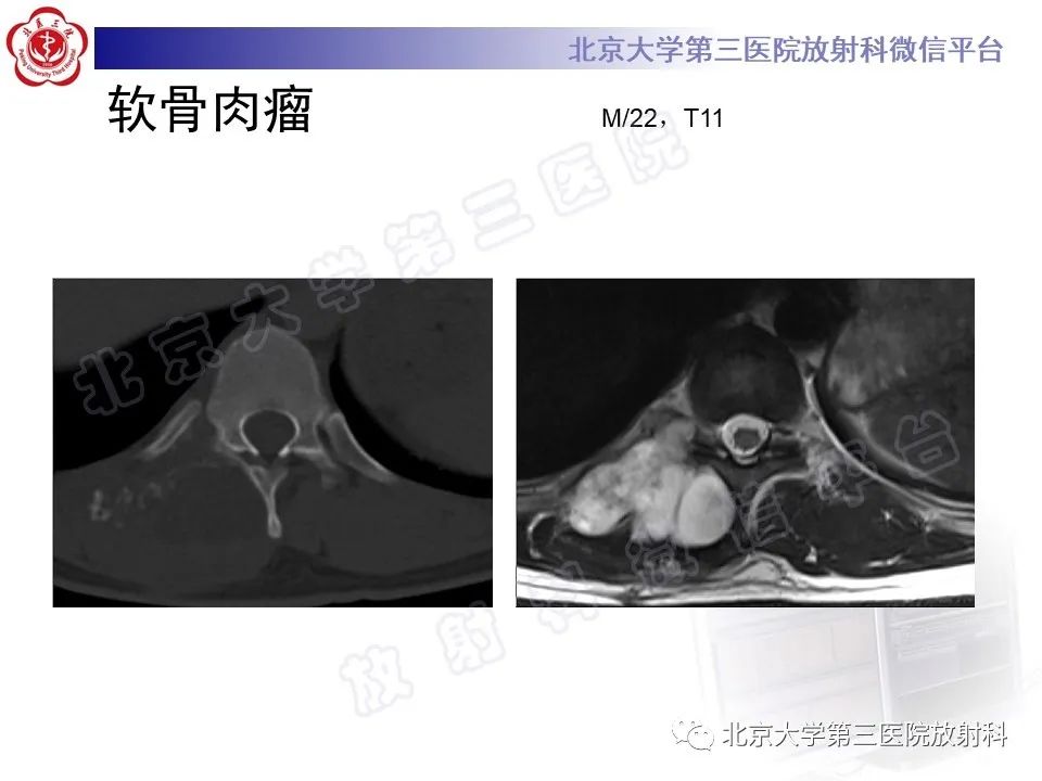 影像PPT - 【PPT】脊柱软骨肉瘤-22