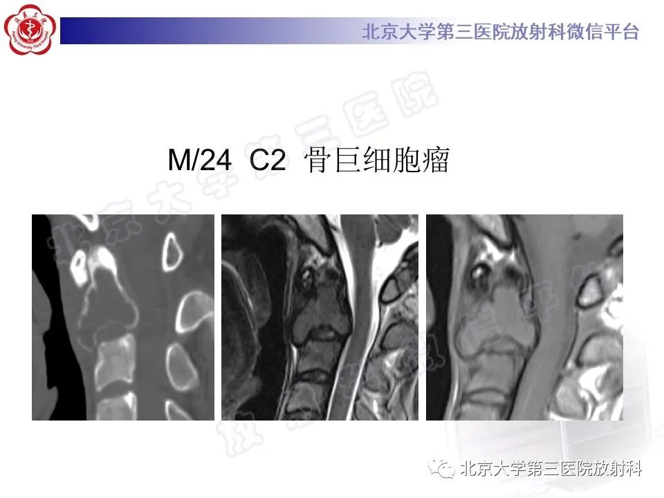 影像PPT - 【PPT】脊柱软骨肉瘤-28