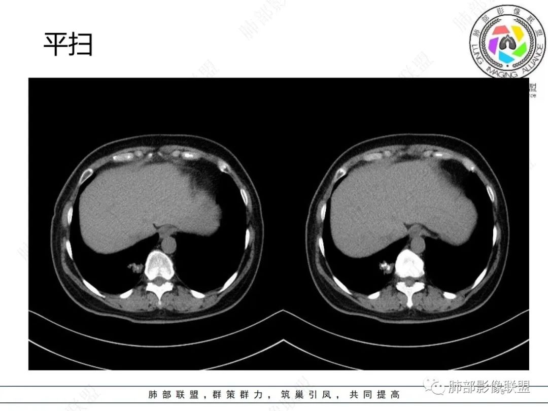 影像PPT - 【病例】发现钙化一定是良性肿瘤吗?-5 影像PPT - 【病例】发现钙化一定是良性肿瘤吗?-5