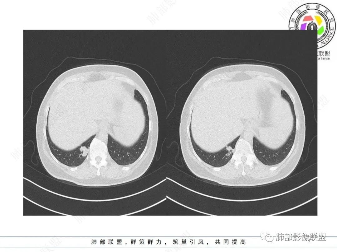 影像PPT - 【病例】发现钙化一定是良性肿瘤吗?-4 影像PPT - 【病例】发现钙化一定是良性肿瘤吗?-4