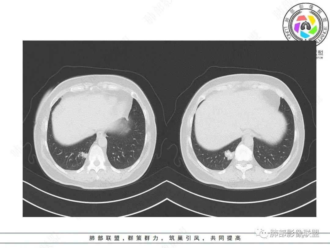 影像PPT - 【病例】发现钙化一定是良性肿瘤吗?-3 影像PPT - 【病例】发现钙化一定是良性肿瘤吗?-3