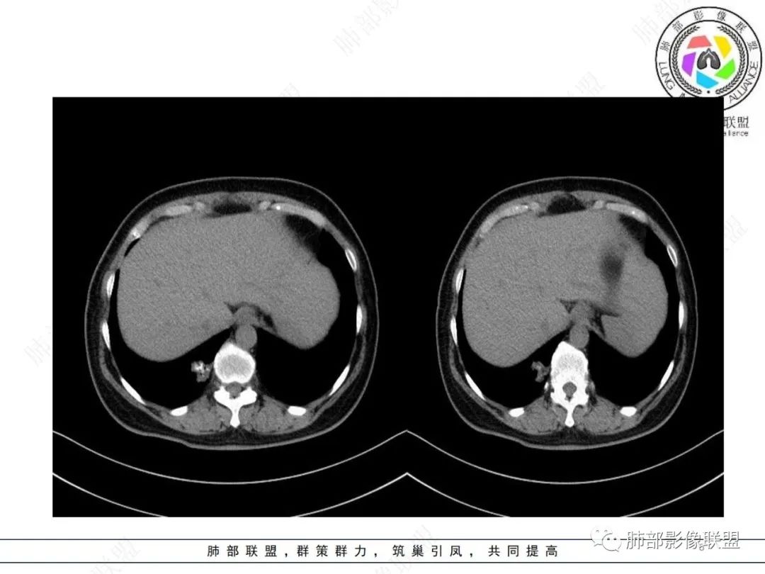 影像PPT - 【病例】发现钙化一定是良性肿瘤吗?-6 影像PPT - 【病例】发现钙化一定是良性肿瘤吗?-6