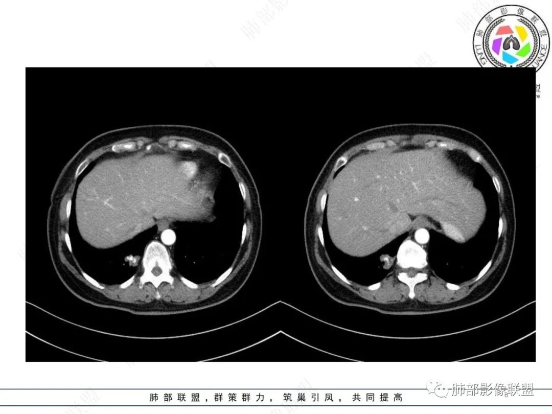 影像PPT - 【病例】发现钙化一定是良性肿瘤吗?-8 影像PPT - 【病例】发现钙化一定是良性肿瘤吗?-8