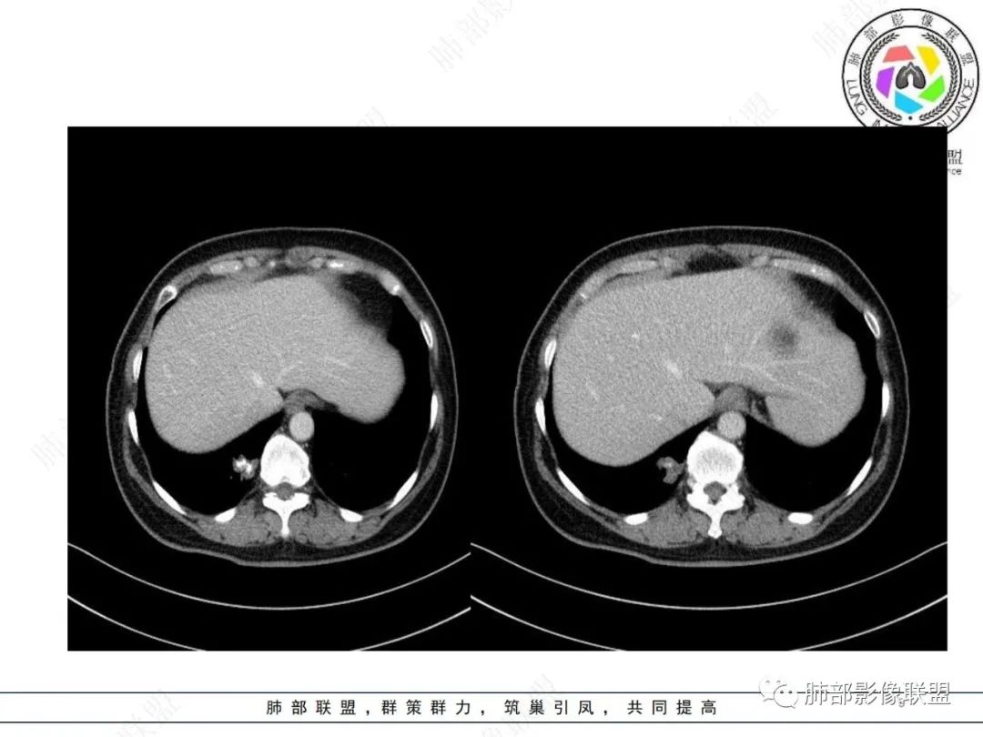 影像PPT - 【病例】发现钙化一定是良性肿瘤吗?-9 影像PPT - 【病例】发现钙化一定是良性肿瘤吗?-9