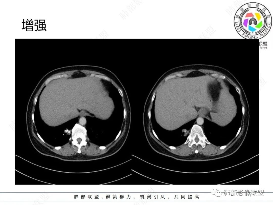 影像PPT - 【病例】发现钙化一定是良性肿瘤吗?-7 影像PPT - 【病例】发现钙化一定是良性肿瘤吗?-7