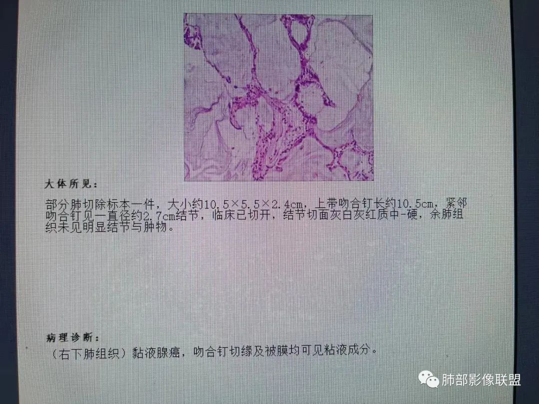 影像PPT - 【病例】发现钙化一定是良性肿瘤吗?-13 影像PPT - 【病例】发现钙化一定是良性肿瘤吗?-13