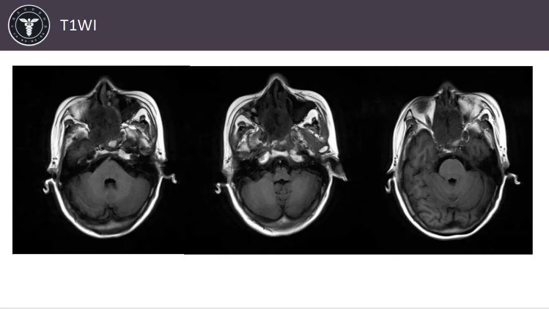 影像PPT - 【病例】鼻腔腺样囊性癌1例CT及MR影像解析-5