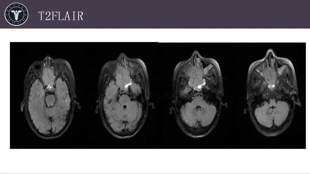 影像PPT - 【病例】鼻腔腺样囊性癌1例CT及MR影像解析-8