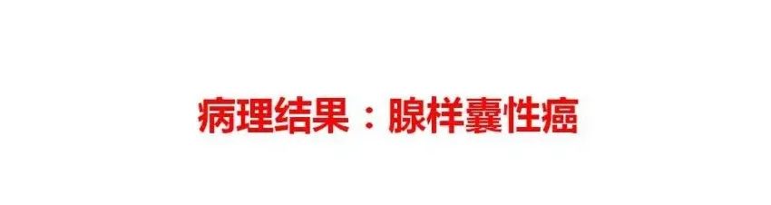 影像PPT - 【病例】鼻腔腺样囊性癌1例CT及MR影像解析-11