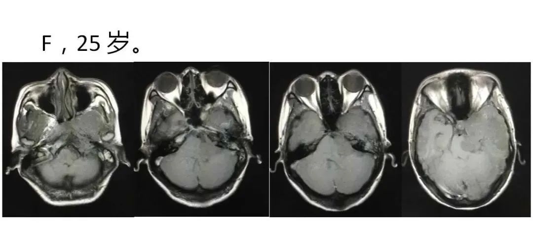 影像PPT - 【病例】鼻腔腺样囊性癌1例CT及MR影像解析-19