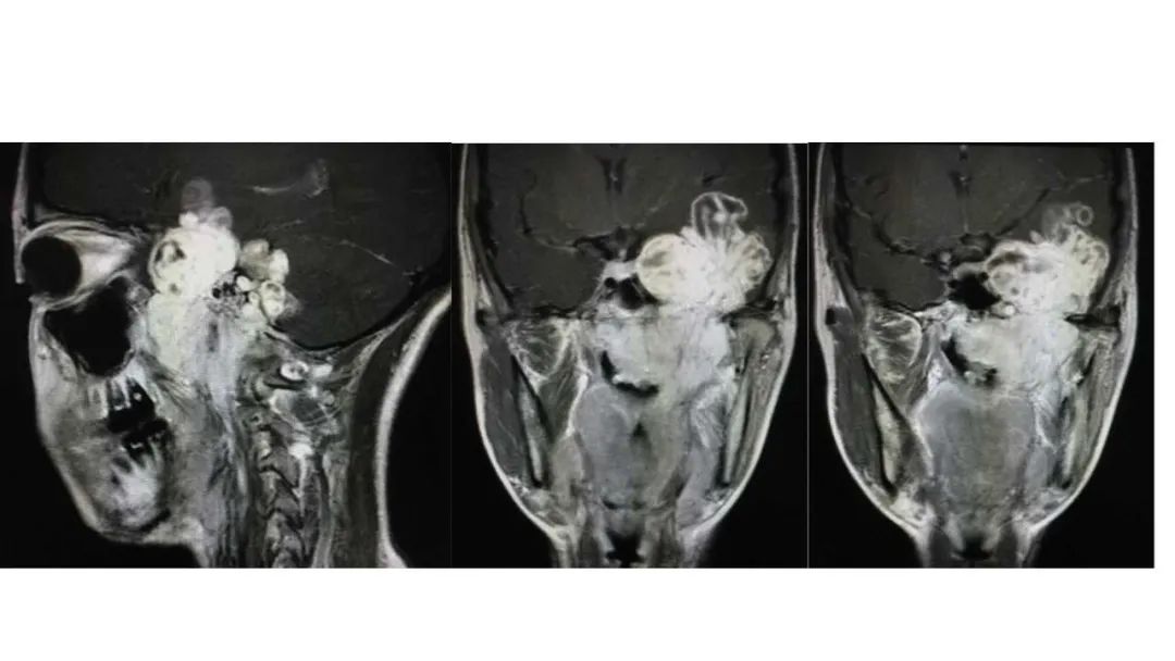 影像PPT - 【病例】鼻腔腺样囊性癌1例CT及MR影像解析-22