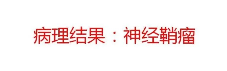 影像PPT - 【病例】鼻腔神经鞘瘤1例CT及MR影像解析-10