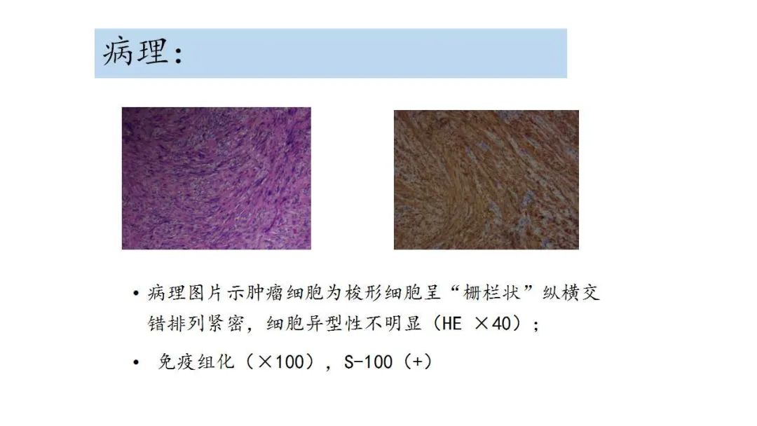 影像PPT - 【病例】鼻腔神经鞘瘤1例CT及MR影像解析-12