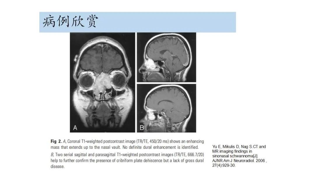 影像PPT - 【病例】鼻腔神经鞘瘤1例CT及MR影像解析-17