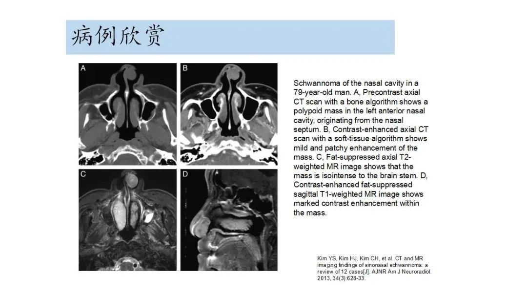 影像PPT - 【病例】鼻腔神经鞘瘤1例CT及MR影像解析-18