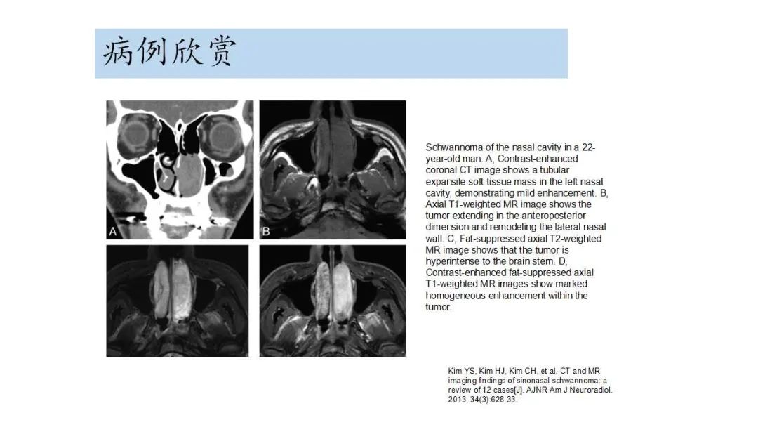 影像PPT - 【病例】鼻腔神经鞘瘤1例CT及MR影像解析-19