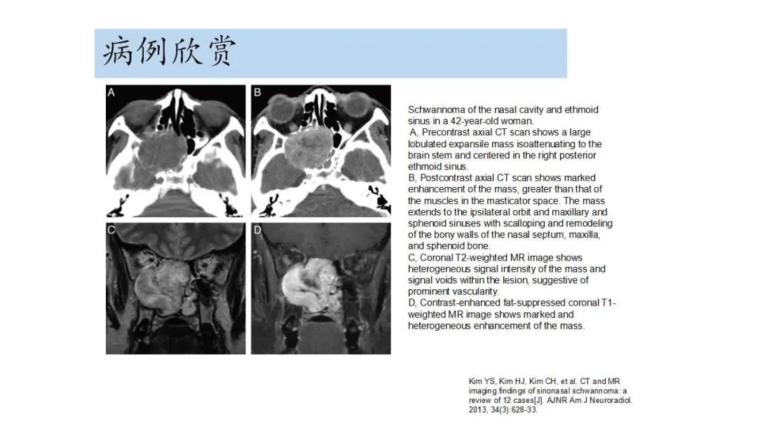 影像PPT - 【病例】鼻腔神经鞘瘤1例CT及MR影像解析-20