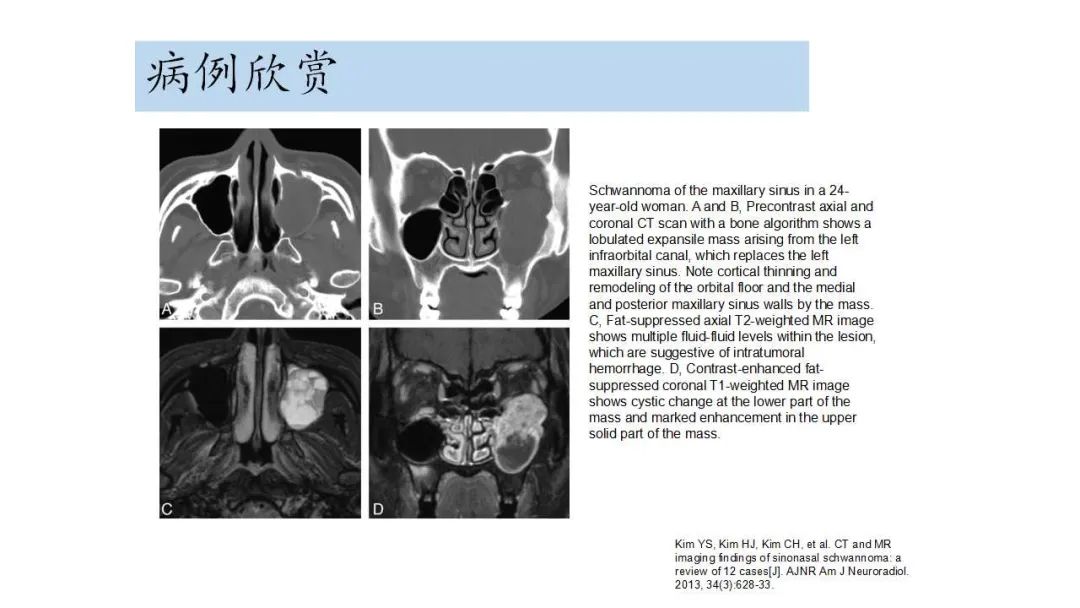 影像PPT - 【病例】鼻腔神经鞘瘤1例CT及MR影像解析-21