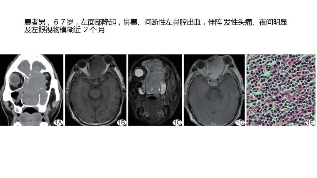 影像PPT - 【病例】鼻腔浆细胞瘤1例CT及MR影像-17
