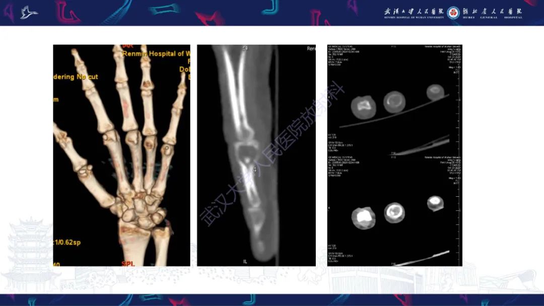 影像PPT - 【PPT】指骨肿瘤影像诊断-7