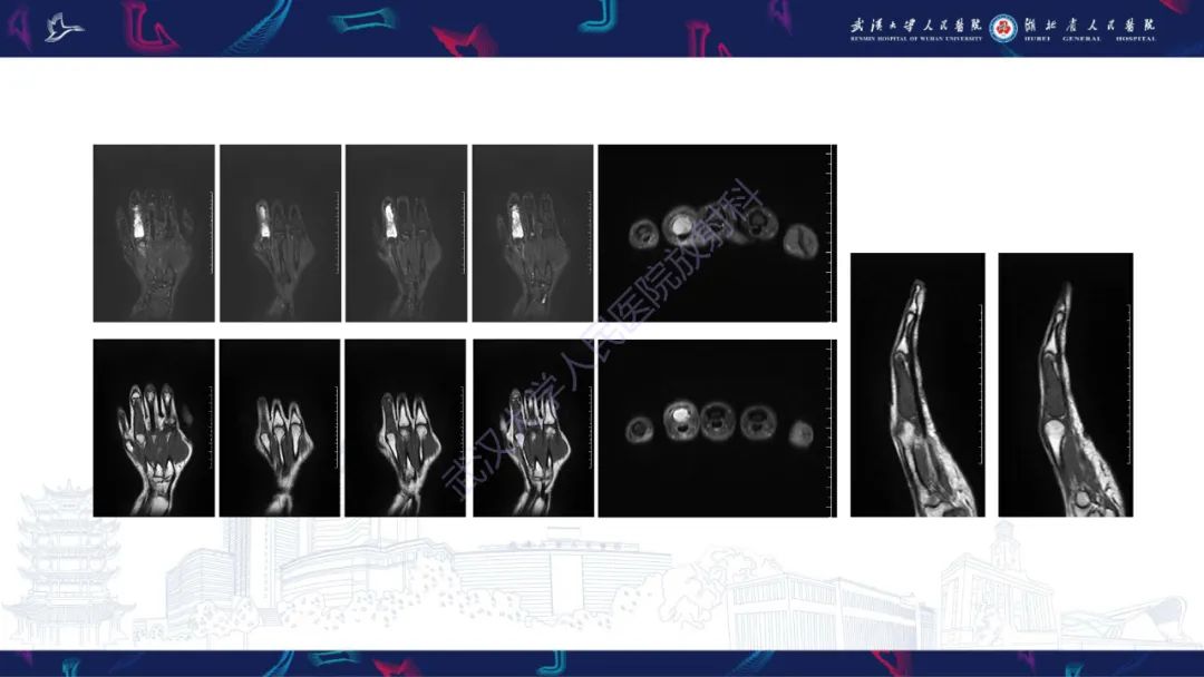 影像PPT - 【PPT】指骨肿瘤影像诊断-4