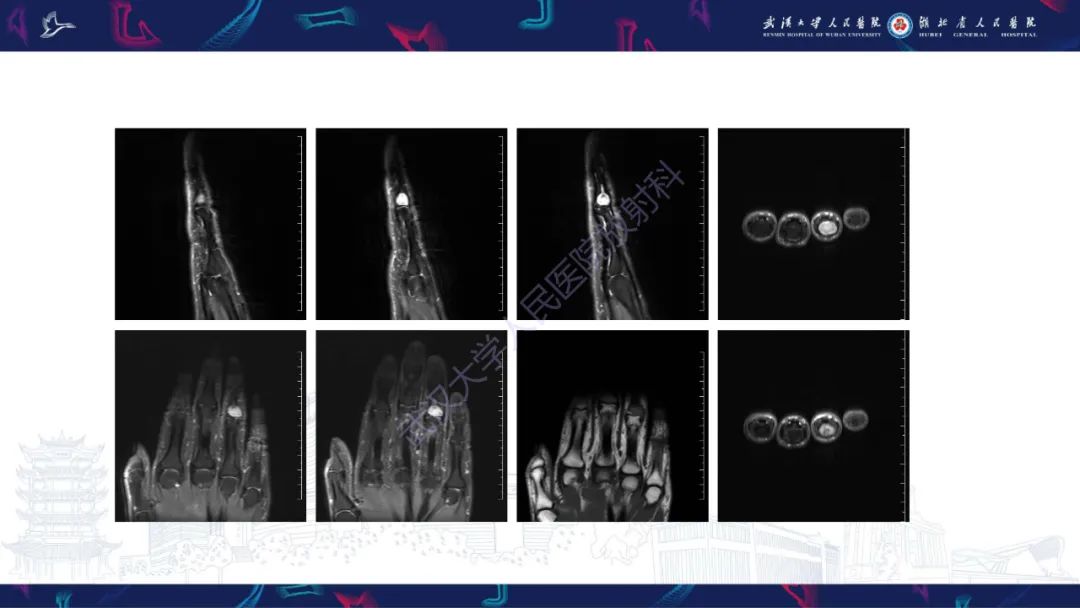 影像PPT - 【PPT】指骨肿瘤影像诊断-8