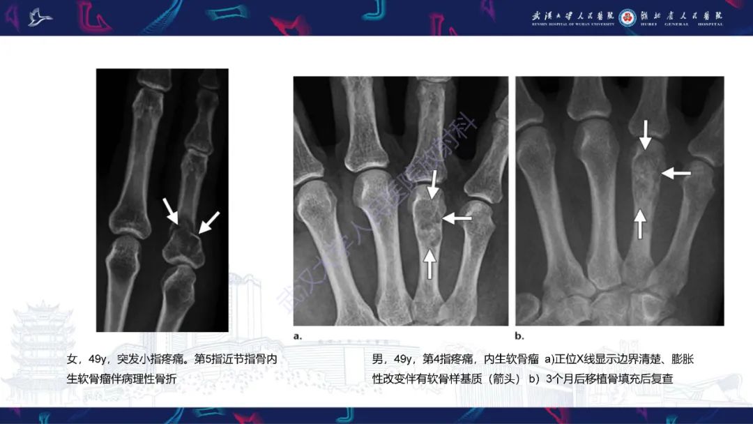影像PPT - 【PPT】指骨肿瘤影像诊断-17