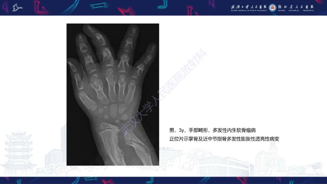 影像PPT - 【PPT】指骨肿瘤影像诊断-19