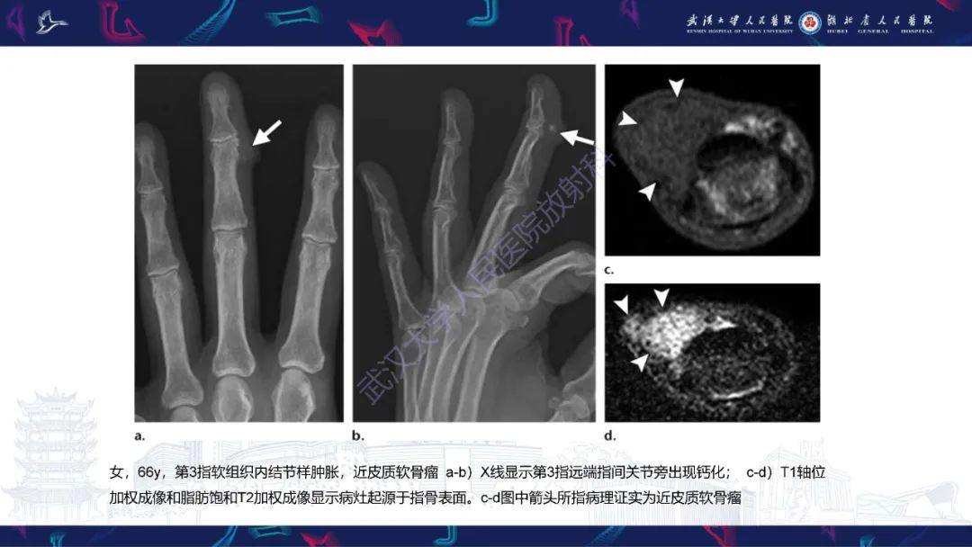 影像PPT - 【PPT】指骨肿瘤影像诊断-21