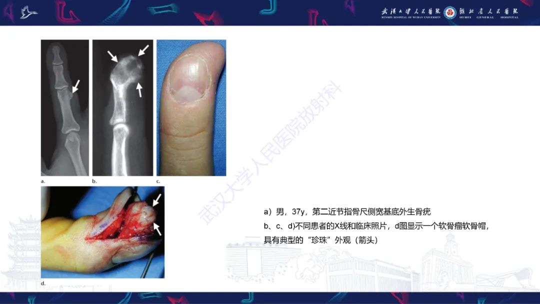 影像PPT - 【PPT】指骨肿瘤影像诊断-23