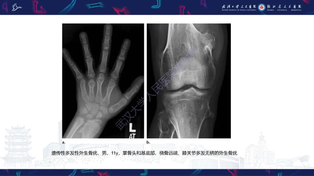 影像PPT - 【PPT】指骨肿瘤影像诊断-26