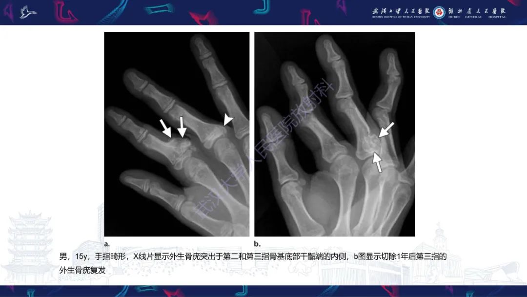影像PPT - 【PPT】指骨肿瘤影像诊断-24