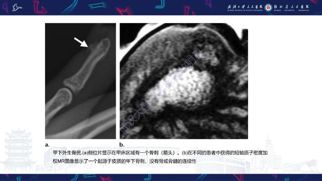 影像PPT - 【PPT】指骨肿瘤影像诊断-29