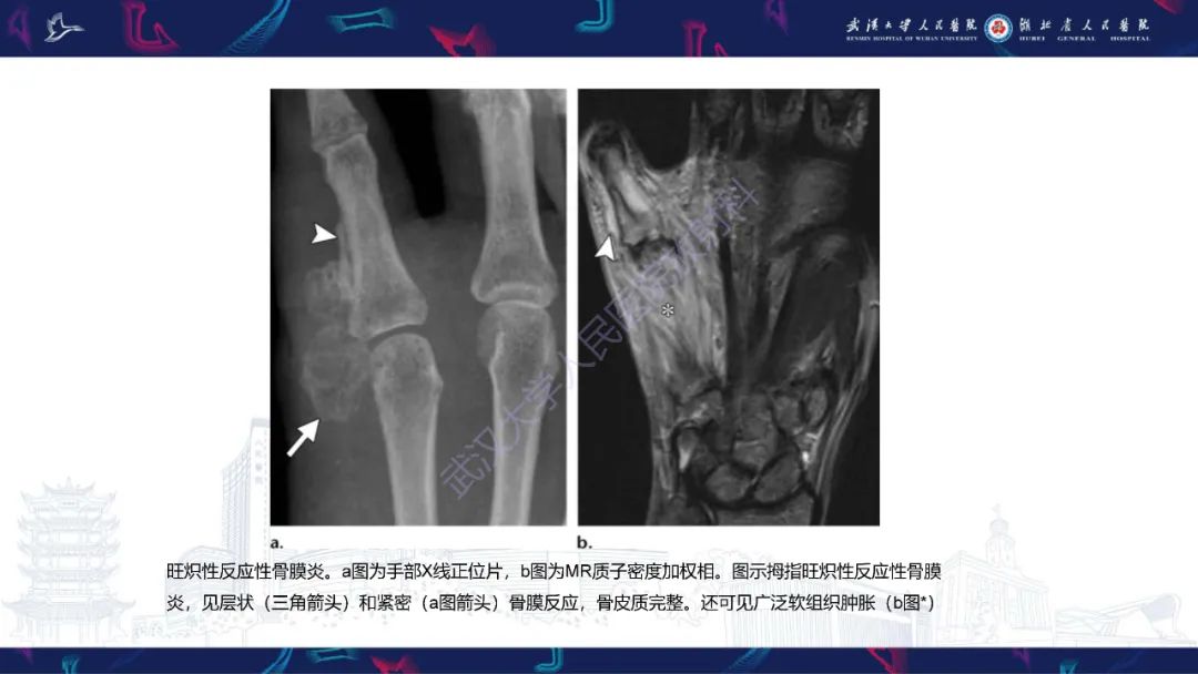 影像PPT - 【PPT】指骨肿瘤影像诊断-31