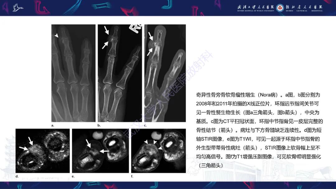 影像PPT - 【PPT】指骨肿瘤影像诊断-34