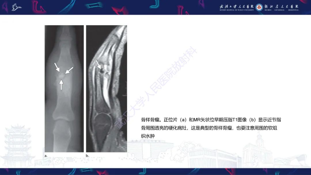 影像PPT - 【PPT】指骨肿瘤影像诊断-37
