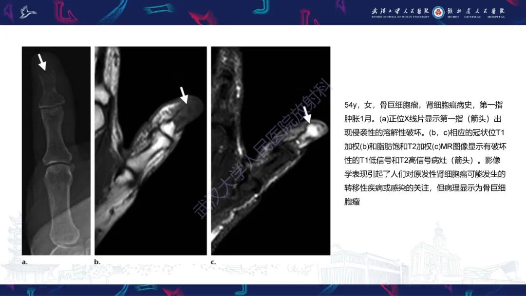 影像PPT - 【PPT】指骨肿瘤影像诊断-40