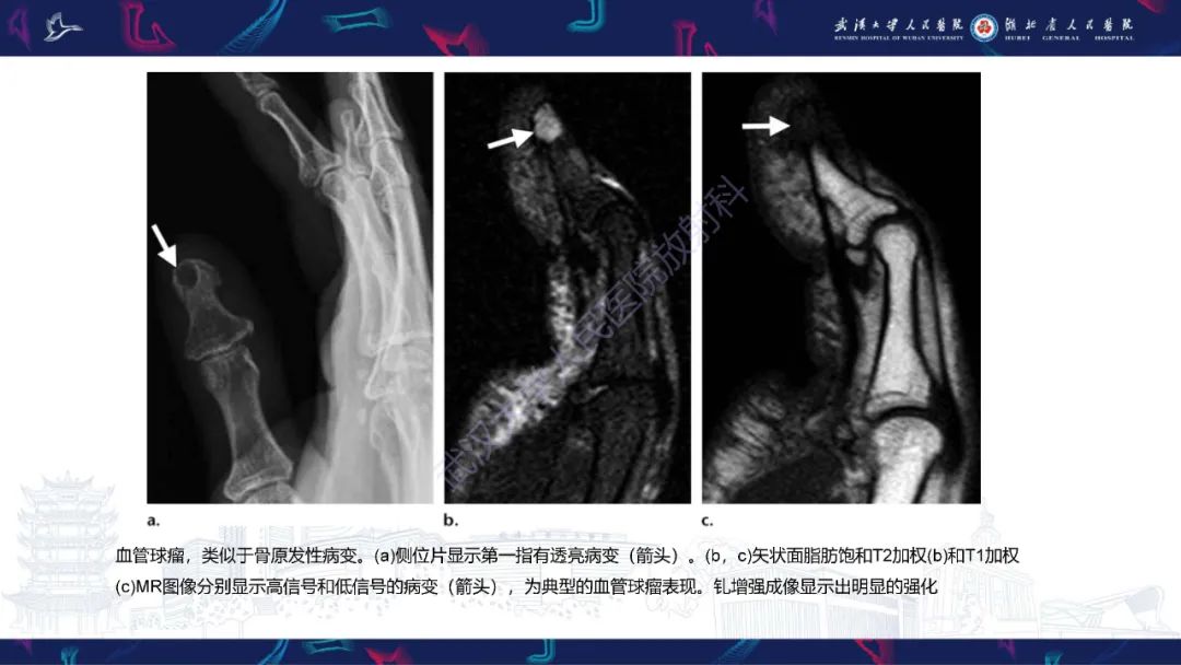 影像PPT - 【PPT】指骨肿瘤影像诊断-42