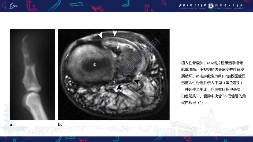 影像PPT - 【PPT】指骨肿瘤影像诊断-44