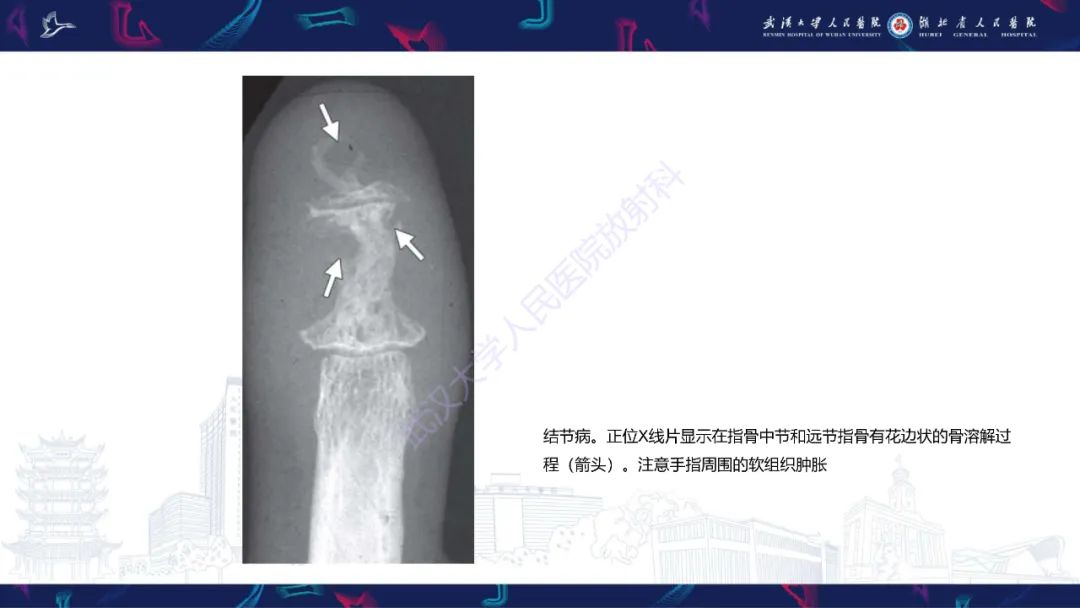 影像PPT - 【PPT】指骨肿瘤影像诊断-46