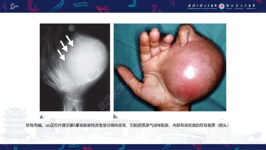 影像PPT - 【PPT】指骨肿瘤影像诊断-49