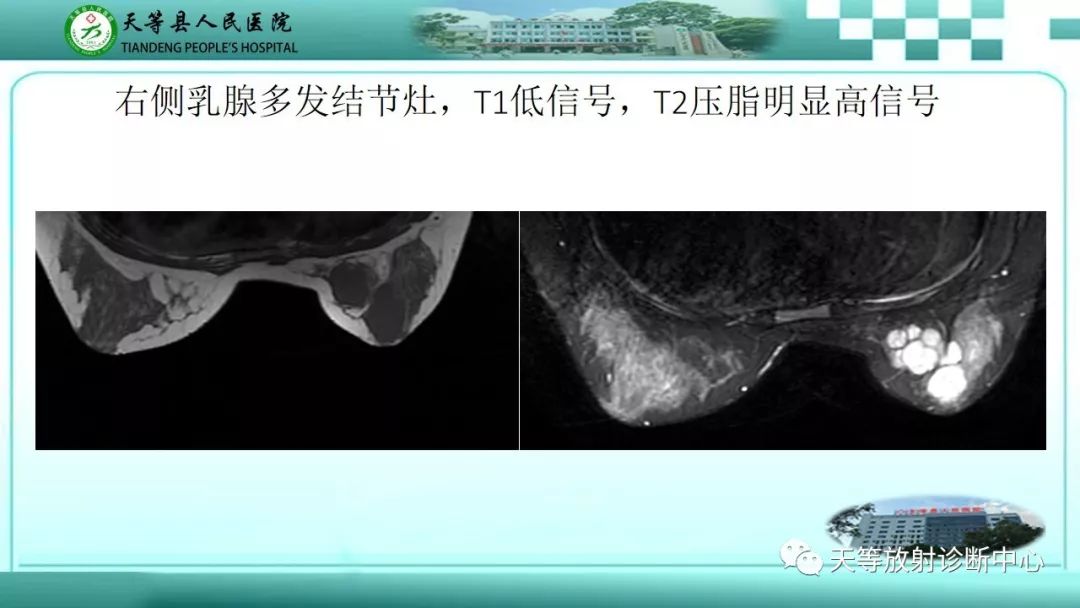 影像PPT - 【病例】乳腺纤维腺瘤1例MR影像-1 影像PPT - 【病例】乳腺纤维腺瘤1例MR影像-1