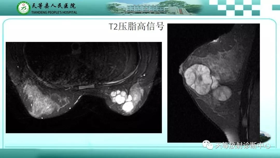 影像PPT - 【病例】乳腺纤维腺瘤1例MR影像-2 影像PPT - 【病例】乳腺纤维腺瘤1例MR影像-2