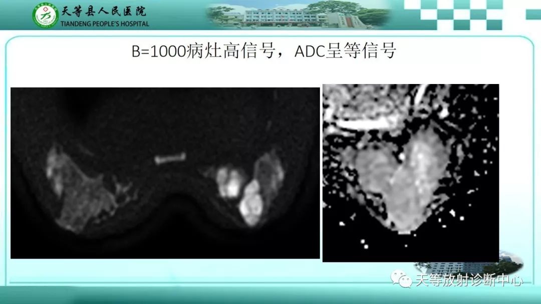 影像PPT - 【病例】乳腺纤维腺瘤1例MR影像-3 影像PPT - 【病例】乳腺纤维腺瘤1例MR影像-3