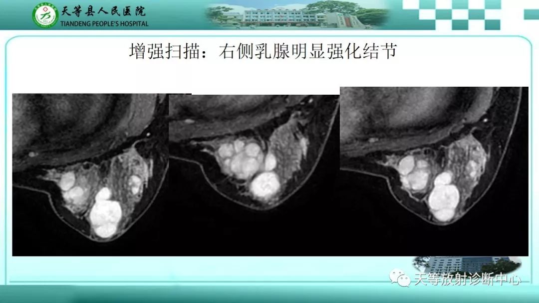 影像PPT - 【病例】乳腺纤维腺瘤1例MR影像-4 影像PPT - 【病例】乳腺纤维腺瘤1例MR影像-4