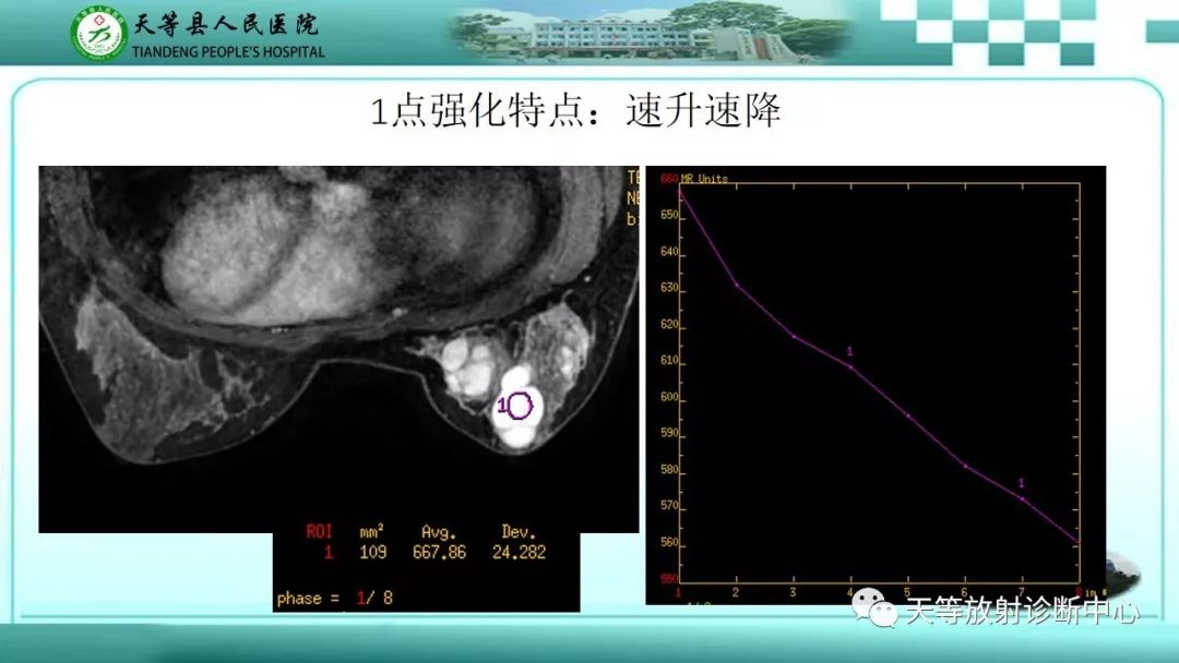 影像PPT - 【病例】乳腺纤维腺瘤1例MR影像-5 影像PPT - 【病例】乳腺纤维腺瘤1例MR影像-5