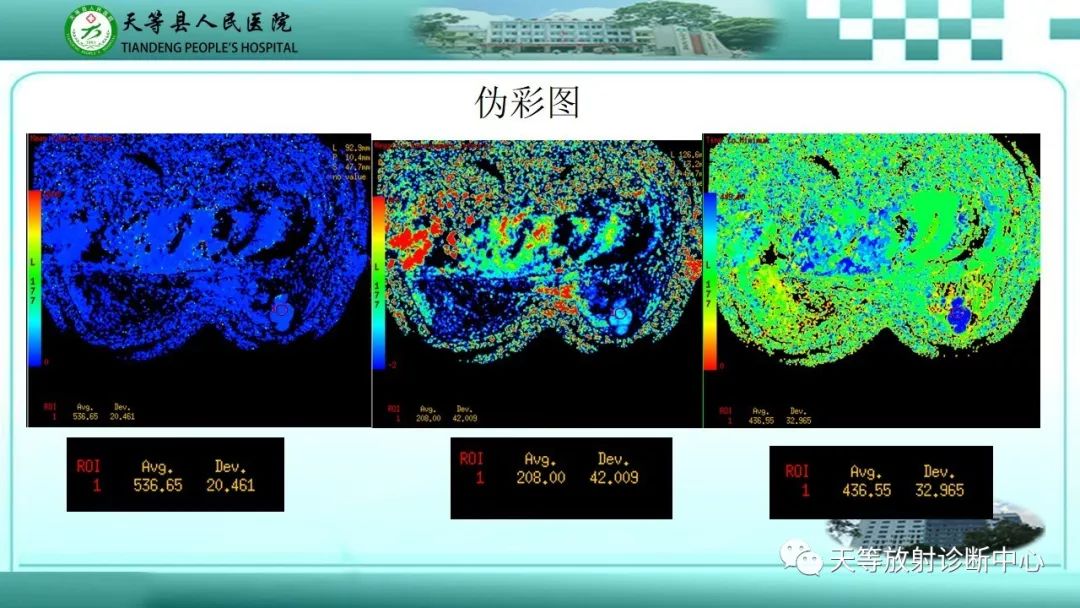 影像PPT - 【病例】乳腺纤维腺瘤1例MR影像-6 影像PPT - 【病例】乳腺纤维腺瘤1例MR影像-6