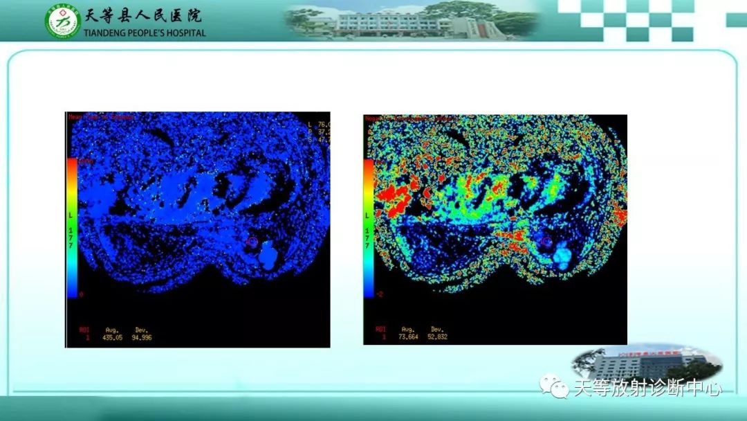 影像PPT - 【病例】乳腺纤维腺瘤1例MR影像-8 影像PPT - 【病例】乳腺纤维腺瘤1例MR影像-8