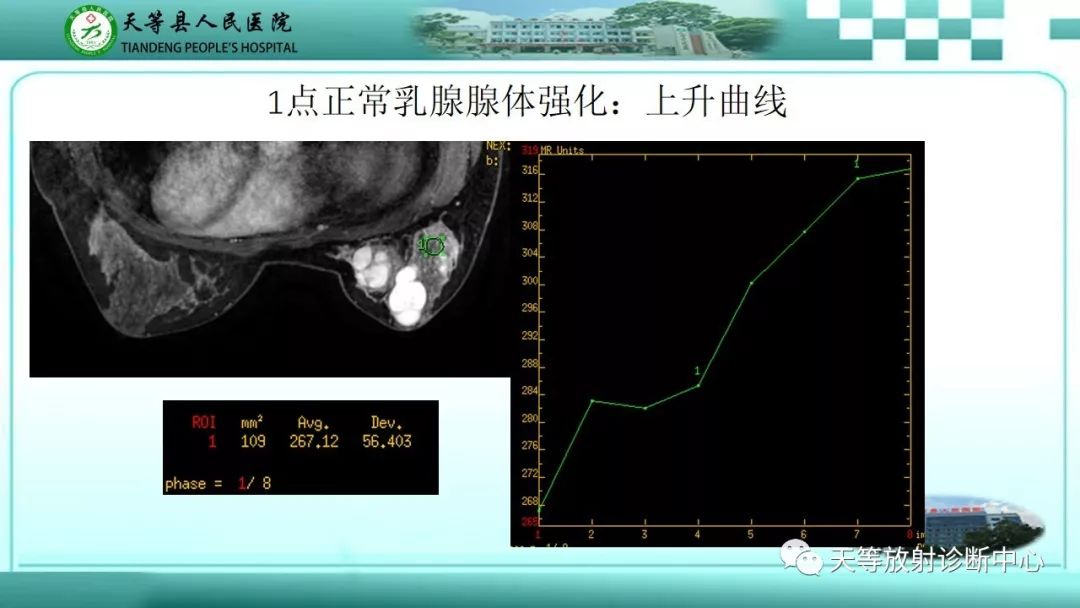影像PPT - 【病例】乳腺纤维腺瘤1例MR影像-9 影像PPT - 【病例】乳腺纤维腺瘤1例MR影像-9