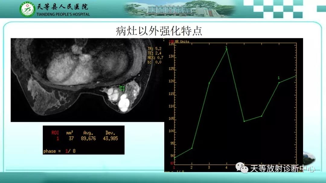 影像PPT - 【病例】乳腺纤维腺瘤1例MR影像-11 影像PPT - 【病例】乳腺纤维腺瘤1例MR影像-11